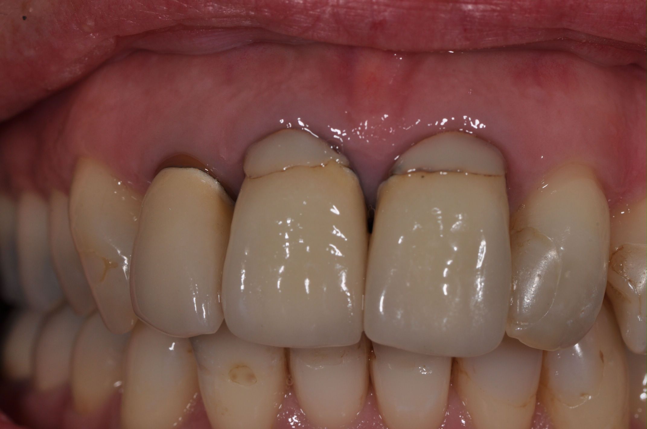 langs eten onderschrift Esthetische tandheelkunde - Onze behandelingen | De Drietand - Maastricht